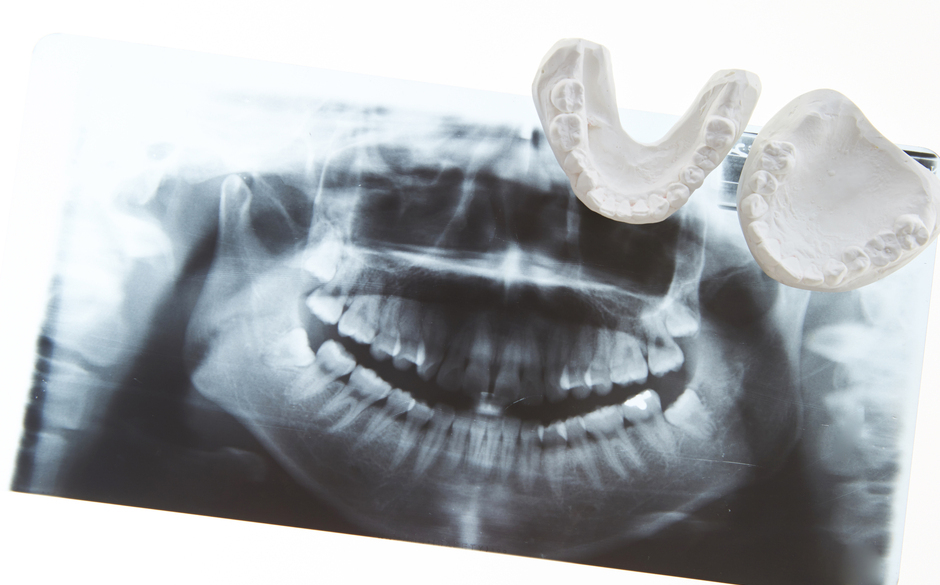 STEP4 かみ合わせの調整
