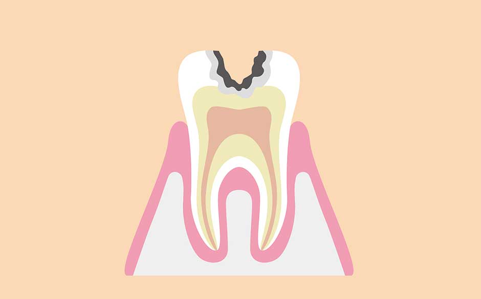 象牙質に進行したむし歯（C2）