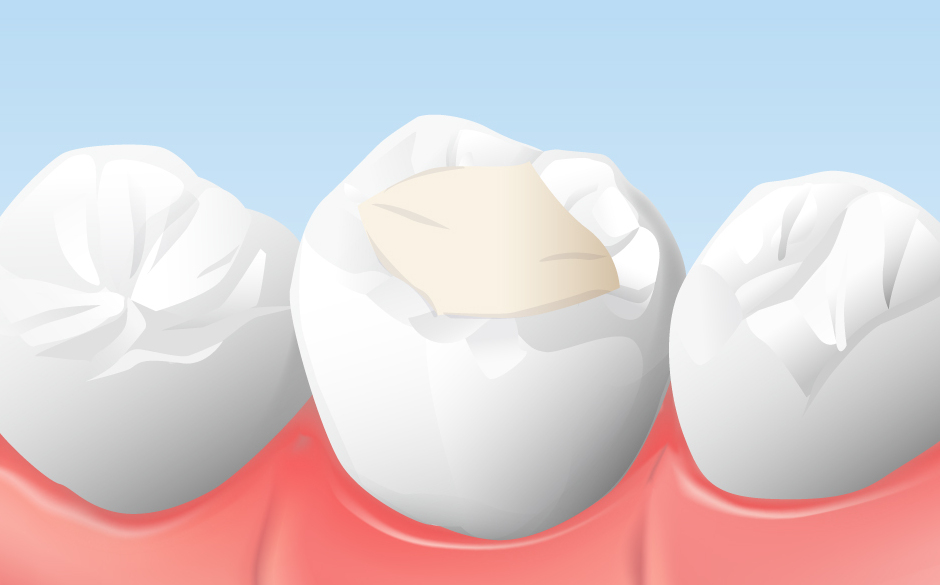 コンポジットレジン充填イメージ