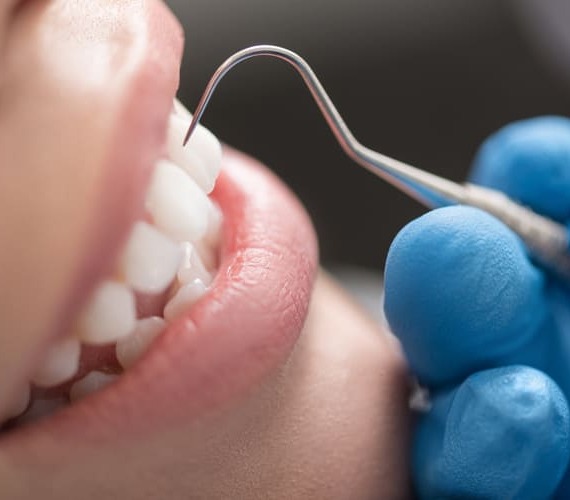 予防・クリーニング