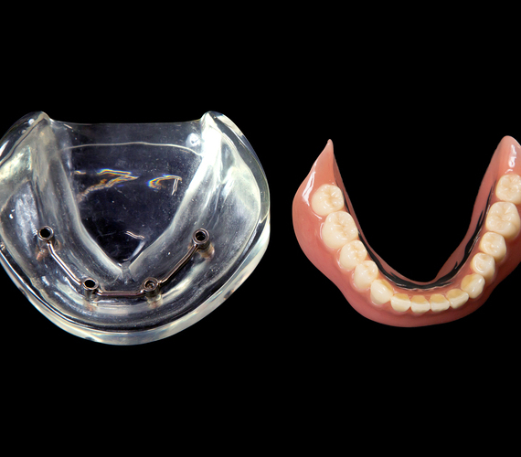 インプラントオーバーデンチャー