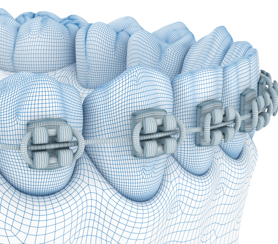 ワイヤー矯正とは