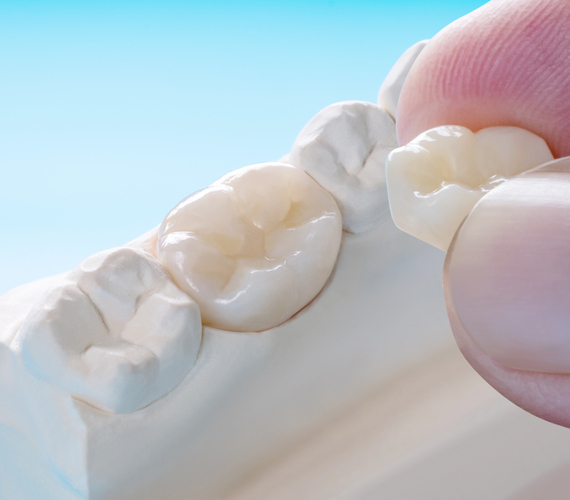 しっかり噛めて長持ちする詰め物・被せ物