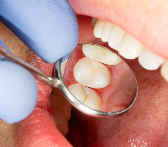 詰め物・被せ物