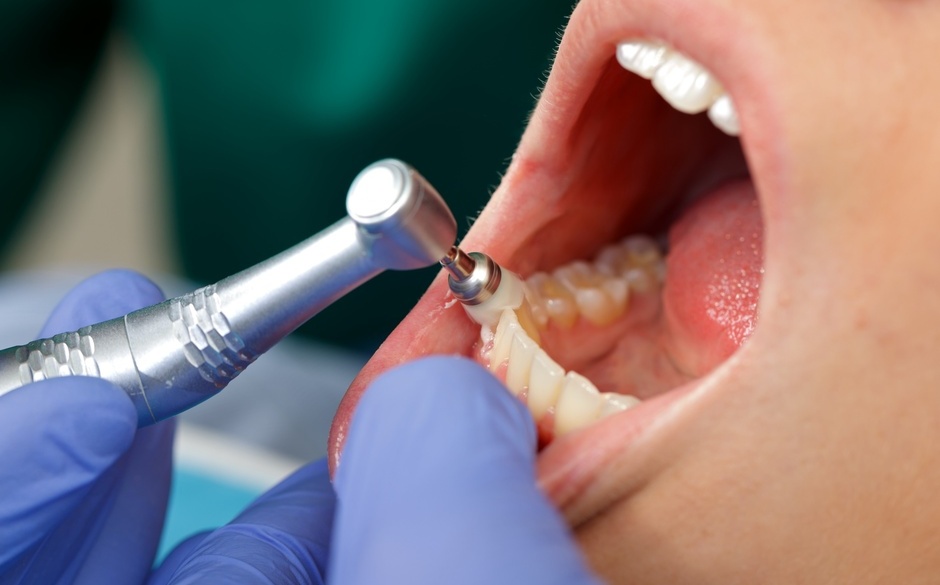 STEP4 歯のクリーニング